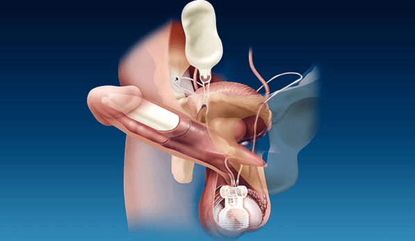 Filler siliconici e gel a spessore
